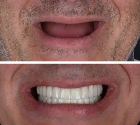 Mini Implant Denture in Gulfport, MS | Book a Free Consultation