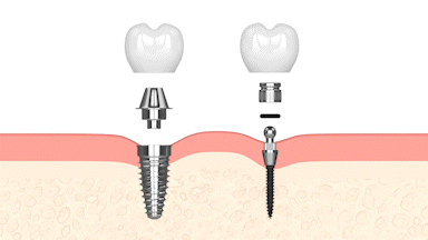 Precio de Mini Implantes Dentales en Gulfport, MS | Dr. John Hopkins