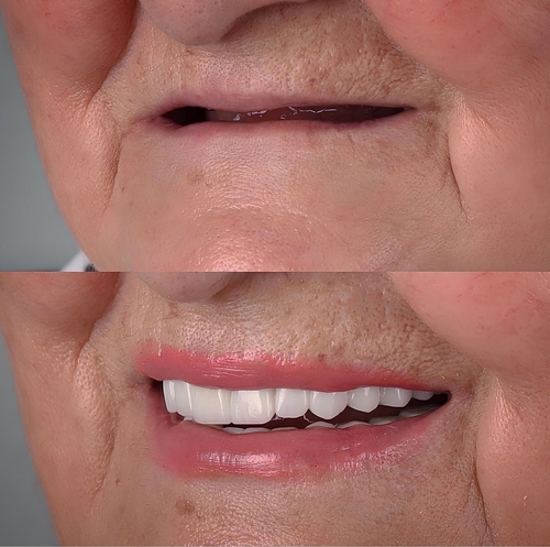 Mini Implantes Dentales en toda la boca en Gulfport, MS | Dr. John Hopkins