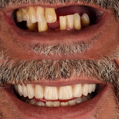Dental Implants in Caesar, MS | Book a Free Implant Consultation