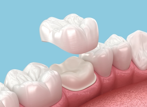 Veneers vs. Crowns in Gulfport, MS | Book a Consultation