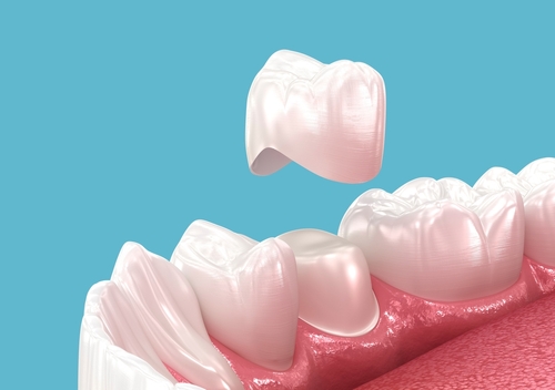 Dental Crown vs. Veneer in Gulfport, MS | Fortify Your Tooth