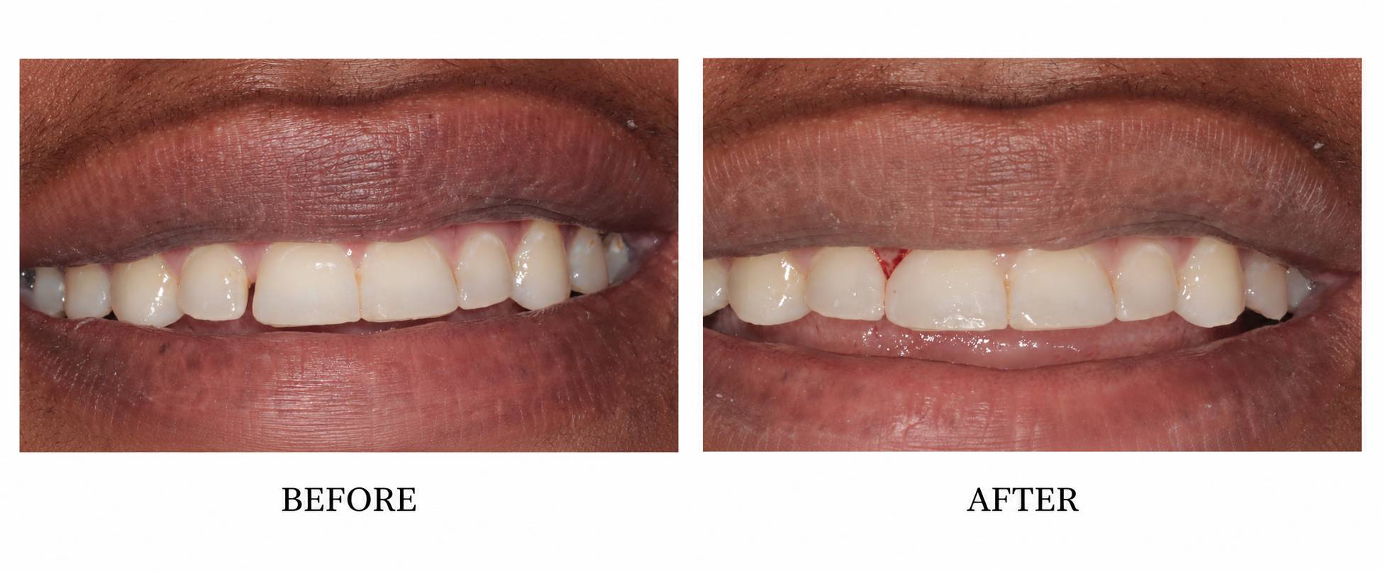 7-8.  Diastema, gap