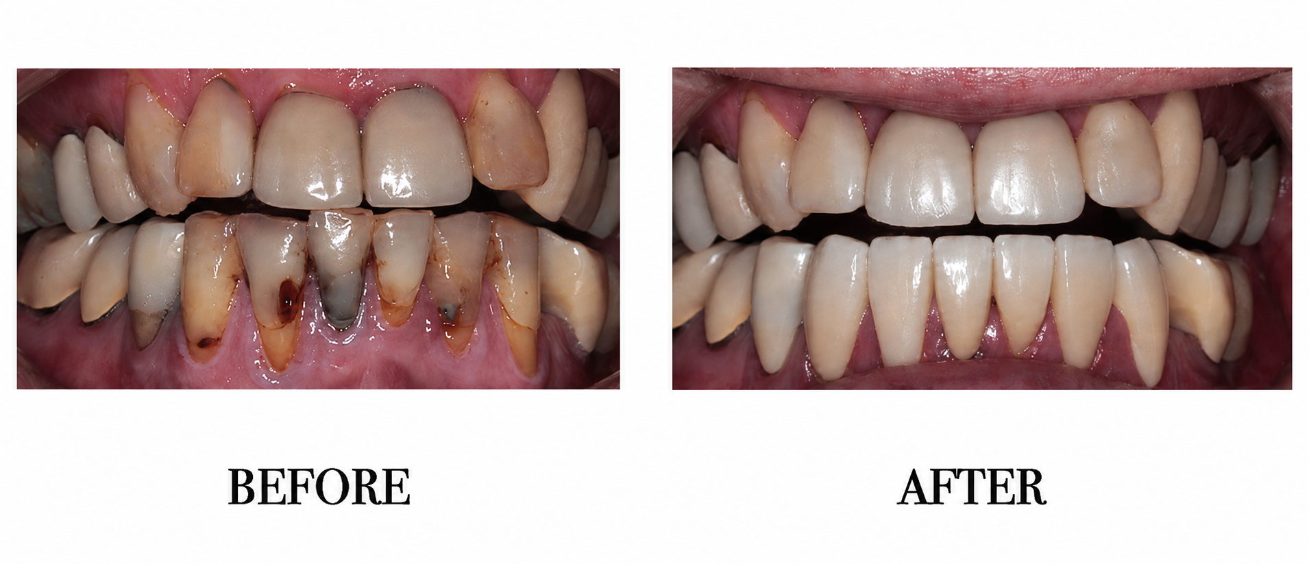 Lower crowns, smile makeover, rehabilitation.